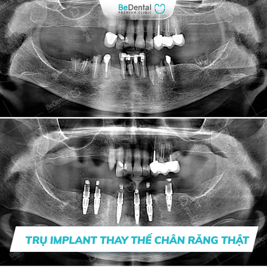 trồng răng implant nào tốt nhất