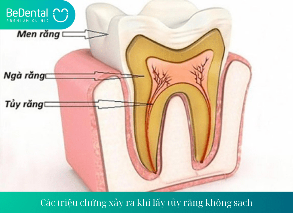 Các triệu chứng xảy ra khi lấy tủy răng không sạch