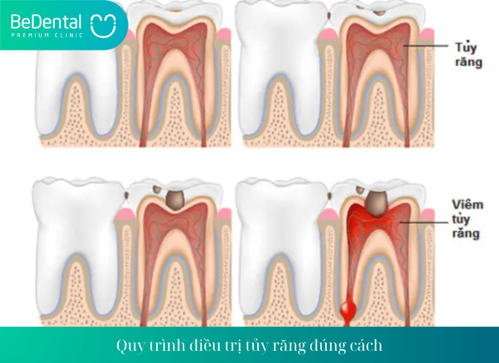 Quy trình điều trị tủy răng đúng cách