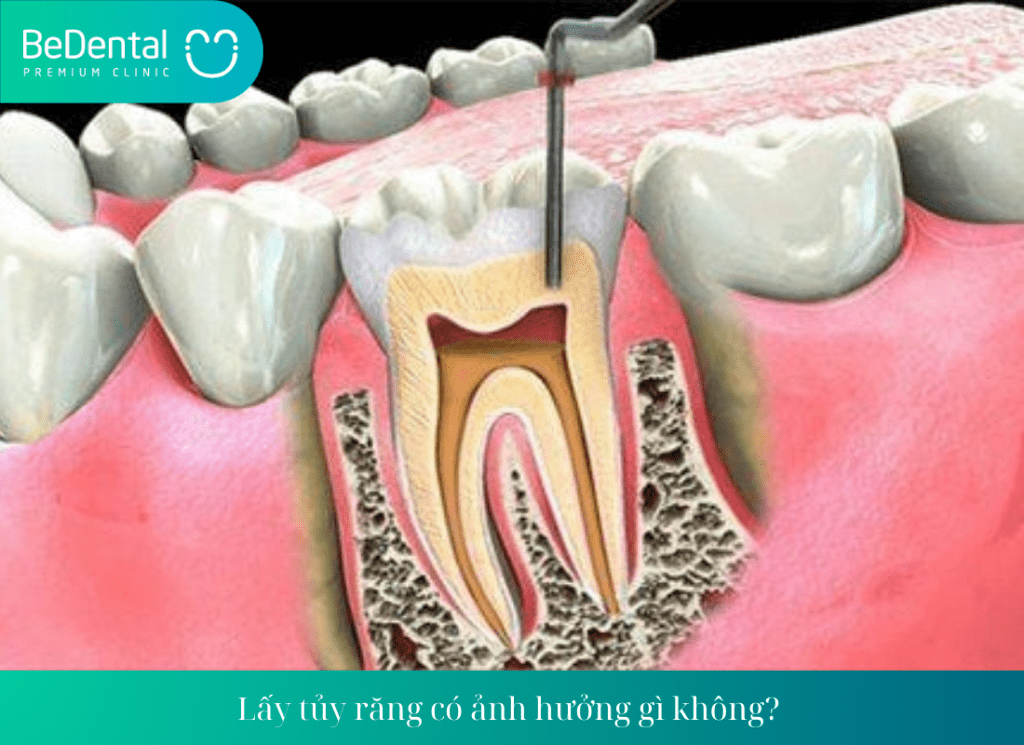 Lấy tủy răng có ảnh hưởng gì không? 