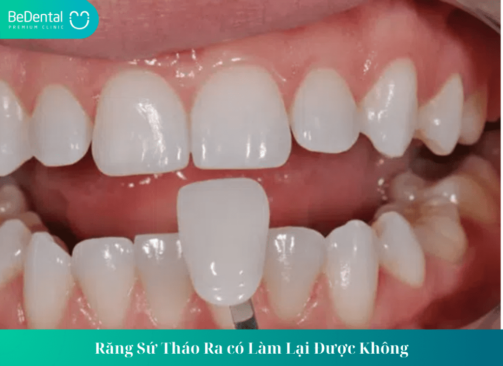 RĂNG SỨ THÁO RA CÓ LÀM LẠI ĐƯỢC KHÔNG