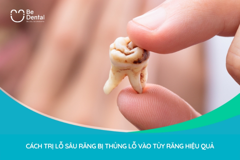 Nếu không điều trị kịp thời, răng bị lủng lỗ đau nhức có thể dẫn đến biến chứng gì?