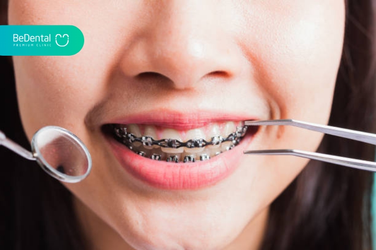 Chế độ chăm sóc răng miêng khi niềng răng