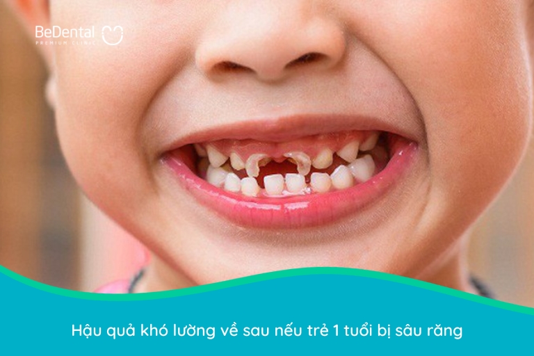 hậu quả khi Trẻ 1 tuổi bị sâu răng 