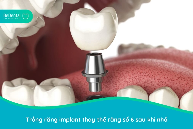 Trồng răng Implant trong trường hợp mất răng số 6