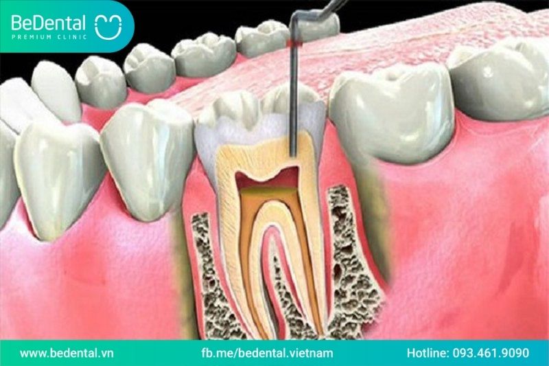 LẤY TỦY RĂNG KHÔNG SẠCH ẢNH HƯỞNG SỨC KHỎE THẾ NÀO?