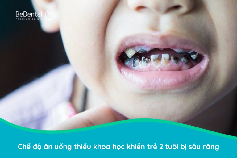 cách chữa sâu răng cho trẻ 2 tuổi