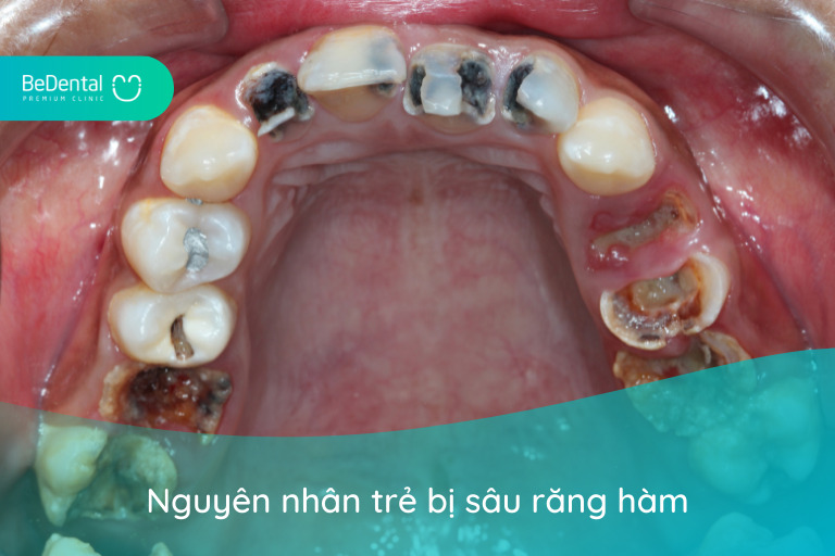 Nguyên nhân trẻ bị sâu răng hàm - trẻ bị sâu răng hàm có mọc lại không
