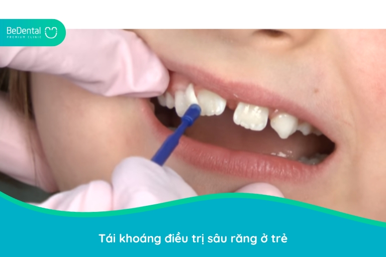 tái khoáng ngừa sâu răng ở trẻ 3 tuổi