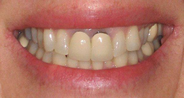 răng sứ bi hỏng sau khi bọc