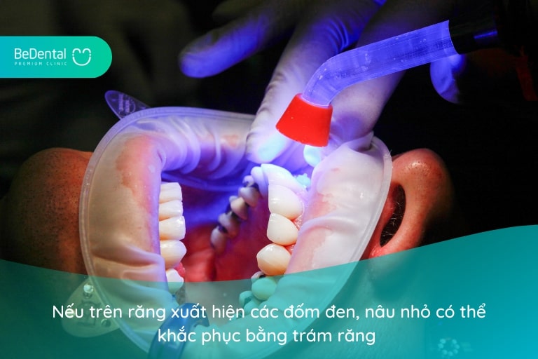 Sâu răng có thể khắc phục bằng trám răng