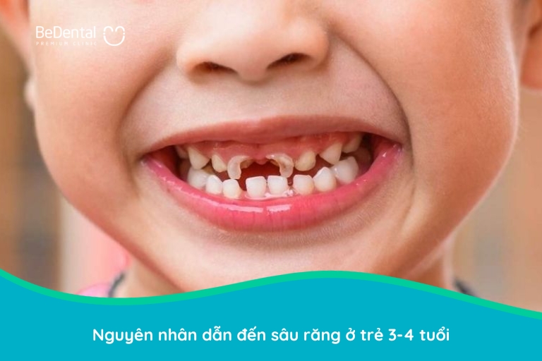 sâu răng ở trẻ em 3 tuổi là do đâu