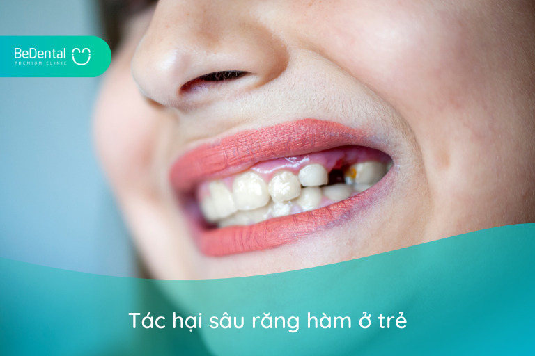 Tác hại sâu răng hàm ở trẻ - trẻ bị sâu răng hàm có mọc lại không