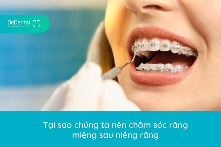 Tại sao chúng ta nên chăm sóc răng miệng sau niềng răng