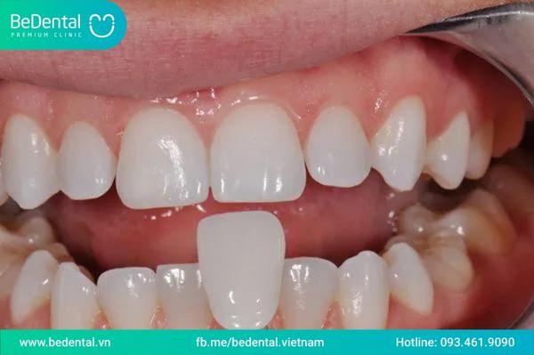 Can porcelain veneers be removed