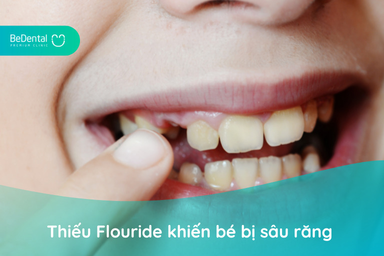 Thiếu Flouride khiến bé 5 tuổi dễ bị sâu răng