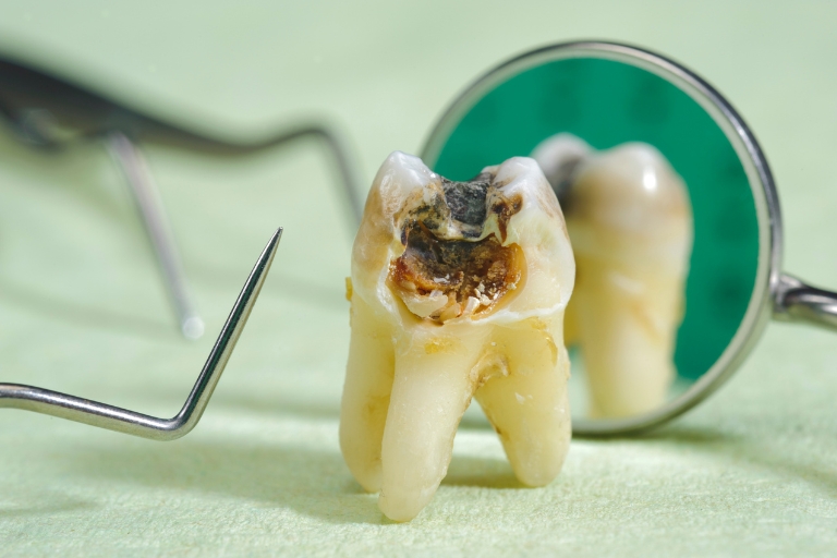 Tác động của sâu răng số 6 đến sức khỏe của trẻ như thế nào?
