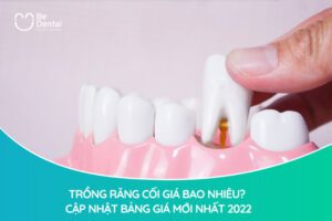 Trồng Răng Cối Giá Bao Nhiêu? Cập Nhật Bảng Giá Mới Nhất 2022