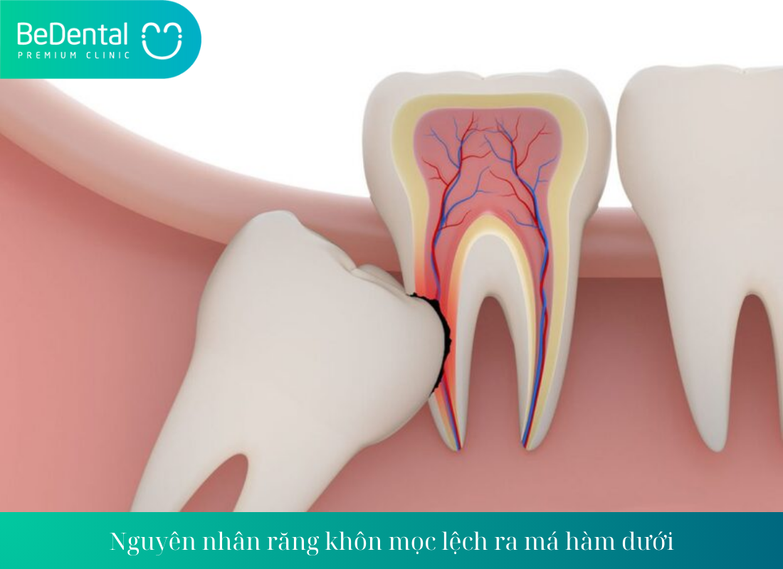 Bọc răng sứ lâu năm bị đau nhức