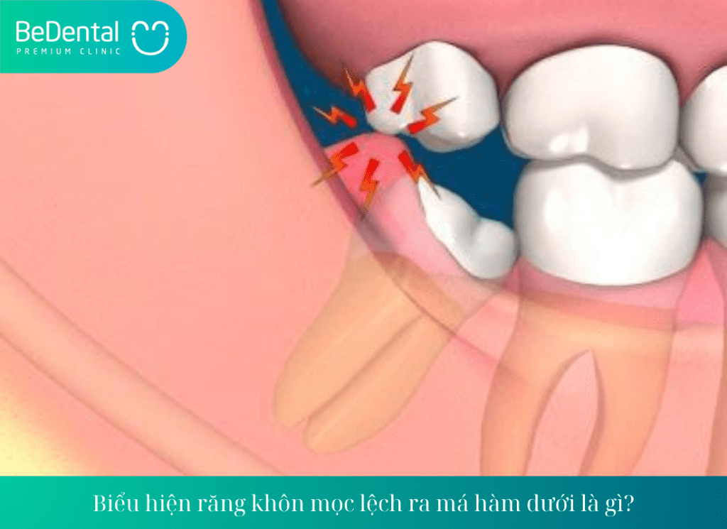 Biểu hiện răng khôn mọc lệch ra má hàm dưới