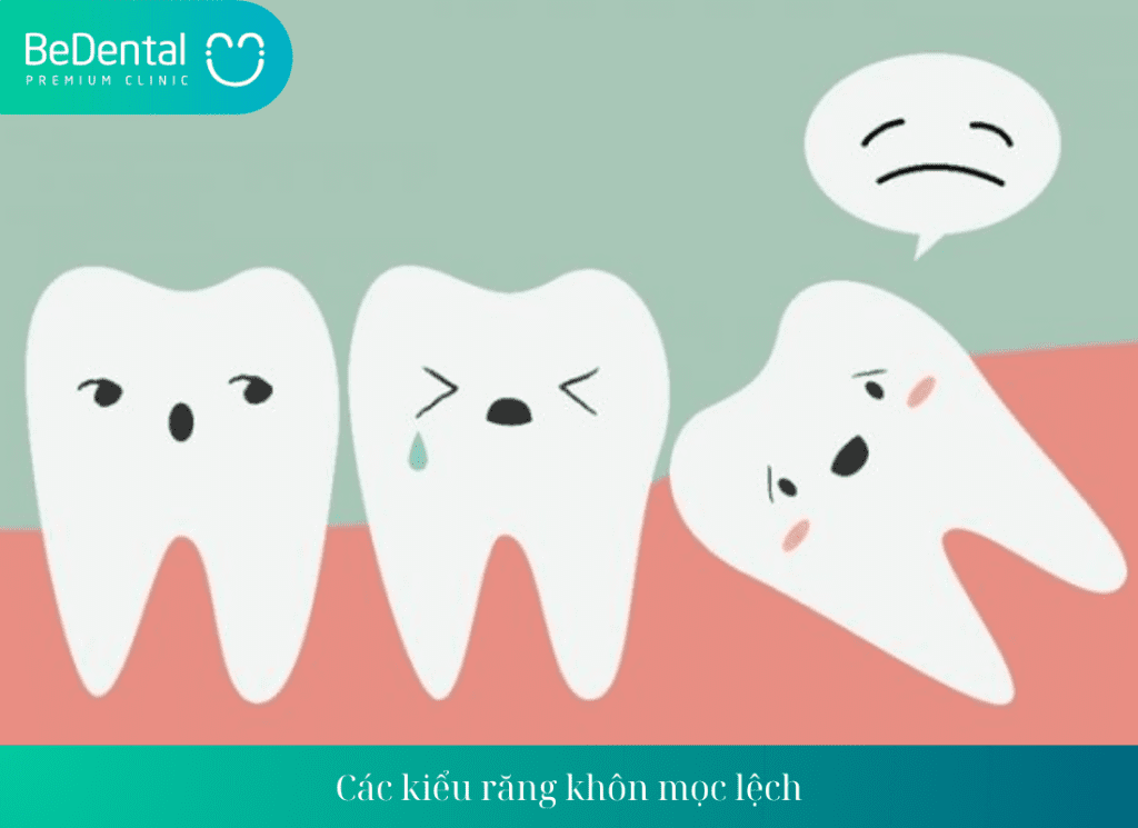 Các kiểu răng khôn mọc lệch