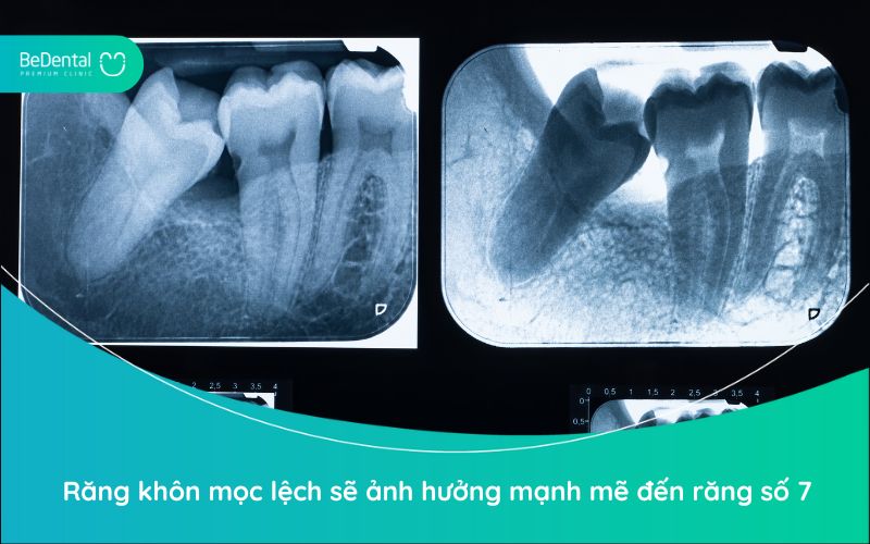 Răng khôn mọc lệch sẽ ảnh hưởng mạnh mẽ đến răng số 7