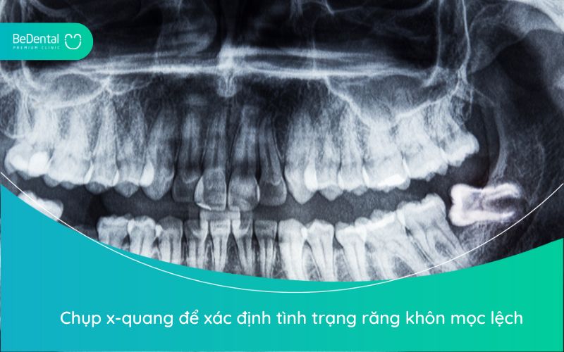 Chụp X-quang để xác định tình trạng răng khôn mọc lệch