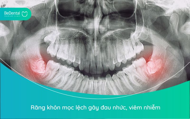 Răng khôn mọc lệch gây đau nhức, viêm nhiễm