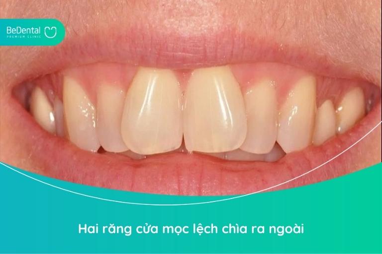 Răng cửa mọc lệch – làm sao cho thẳng và đều trở lại?