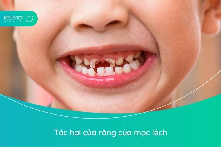Răng cửa mọc sai lệch gây mất thẩm mỹ và ảnh hưởng ít nhiều đến sức khỏe răng