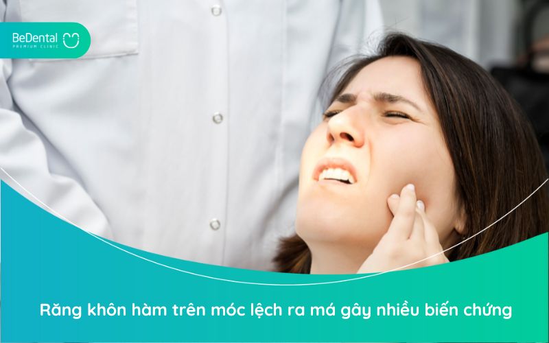 Răng khôn hàm trên mọc lệch ra má gây nhiều biến chứng