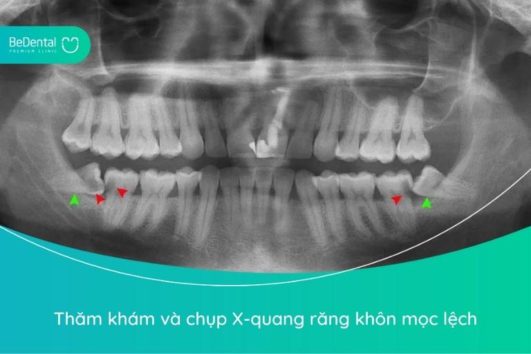 Thăm khám, chụp X-quang kiểm tra tình trạng răng