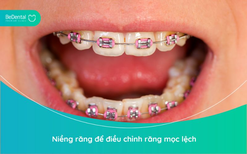 Niềng răng là một phương pháp điều chỉnh răng mọc lệch