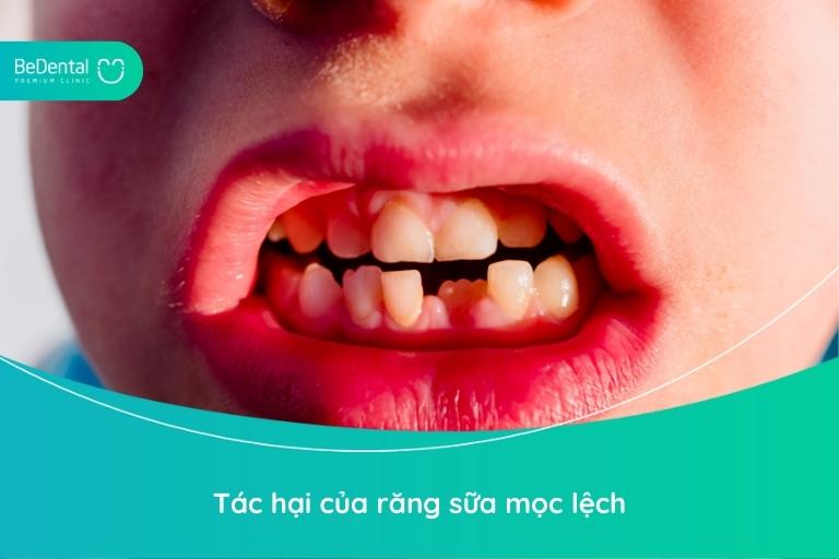 Răng sữa ở trẻ mọc lệch gây ra nhiều tác động xấu đến thẩm mỹ và sinh hoạt hàng ngày