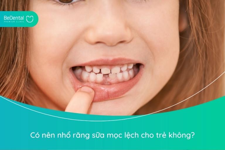 Có nên nhổ răng sữa mọc lệch cho trẻ không là vấn đề được nhiều phụ huynh quan tâm