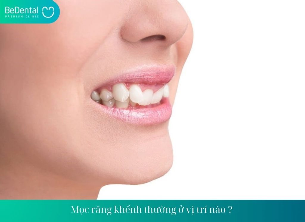 Mọc răng khểnh thường ở vị trí nào ? 