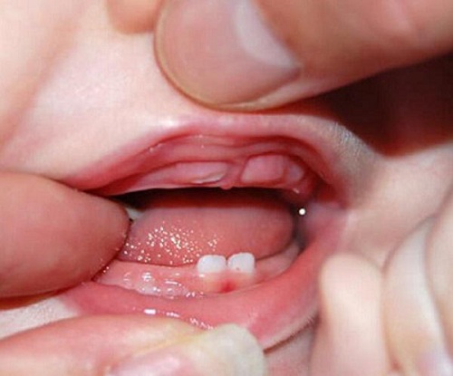 bé mọc răng hàm
