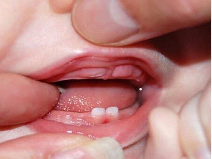 Trẻ bị sốt và tiêu chảy khi mọc răng, mẹ cần làm gì?