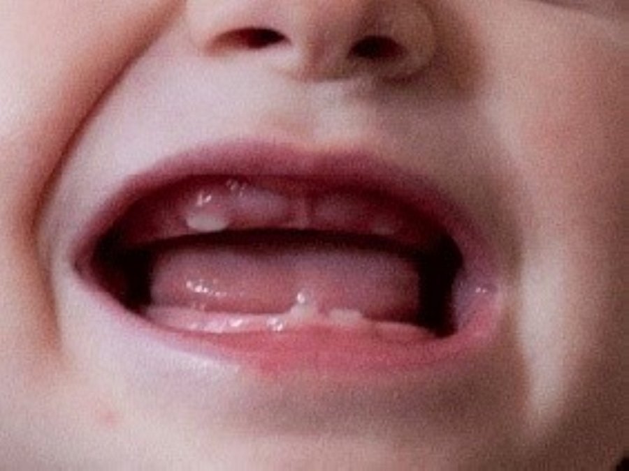 hình ảnh lợi trẻ sắp mọc răng 28