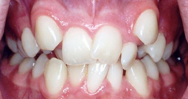 Dấu hiệu nhận biết mọc răng khểnh?