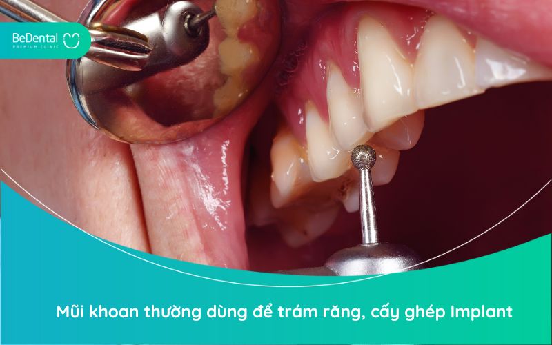 Mũi khoan thường dùng để trám răng, cấy ghép Implant