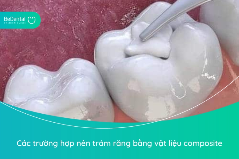 Khi trám răng bằng composite cũng cần phải xem xét tình trạng phù hợp