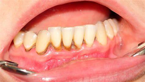 Sún răng ở mức độ nhẹ khi trẻ chỉ bị mòn lớp men răng bên ngoài khiến răng bị sứt mẻ và ố vàng.