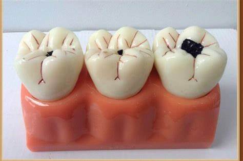 Răng sún ở giai đoạn nặng hơn chuyển dần sang màu đen.