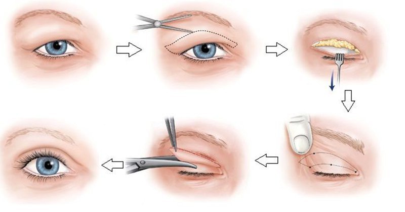 What is monolids? What kind of hair cut should I have for single eyelids? How to turn single eyelids into naturally beautiful double eyelids