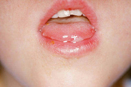 Một số bệnh lở miệng có thể lây qua đường tiếp xúc.