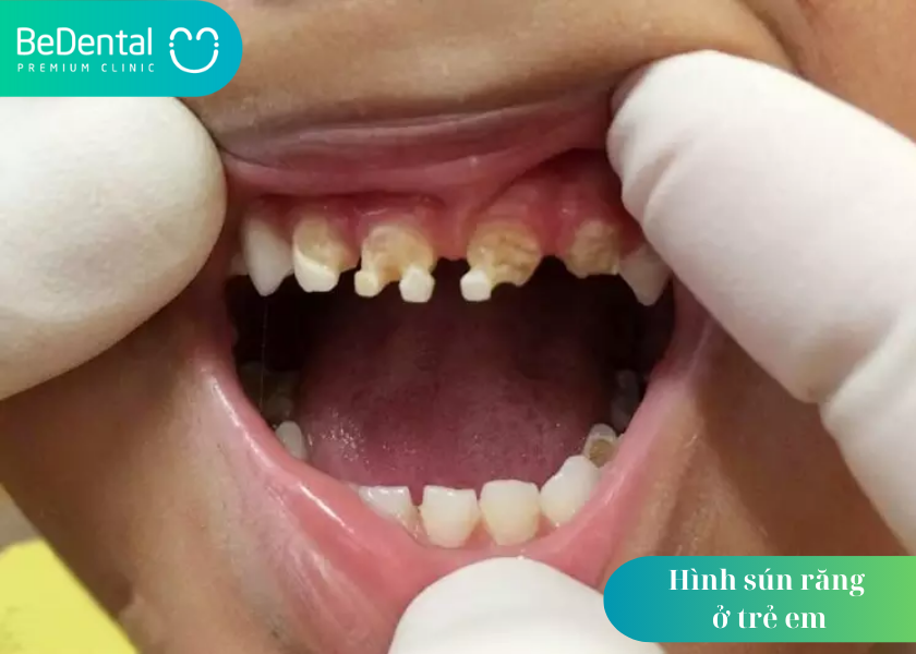 Hình ảnh sún răng: Sún răng ở mức độ nhẹ khi trẻ chỉ bị mòn lớp men răng bên ngoài khiến răng bị sứt mẻ và ố vàng.
