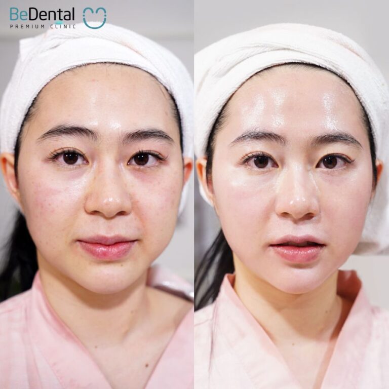 Râu rồng là gì? Tướng số của người râu rồng. 7 cách xóa mờ đường râu ...