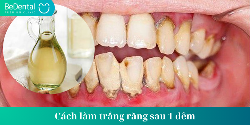 cách làm trắng răng