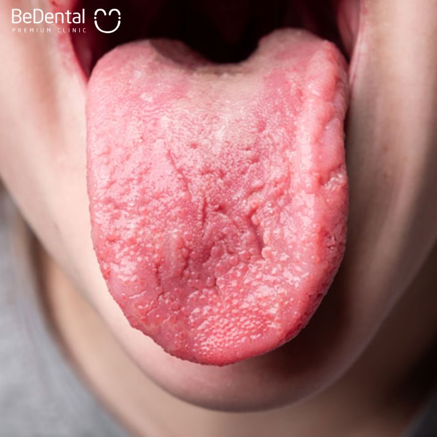 Bệnh viêm lưỡi thường gặp do nhiễm khuẩn, dị ứng,...